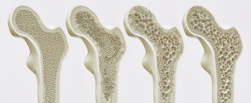 Olive Oil And Osteoporosis